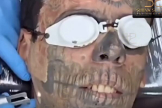 Remoção a laser de tattoo no rosto viraliza na internet